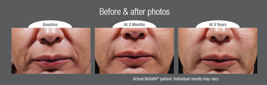 Bellafill Before After